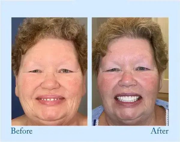 Hidone™ – Premium-Zahnprothese