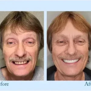 Hidone™ – Premium-Zahnprothese