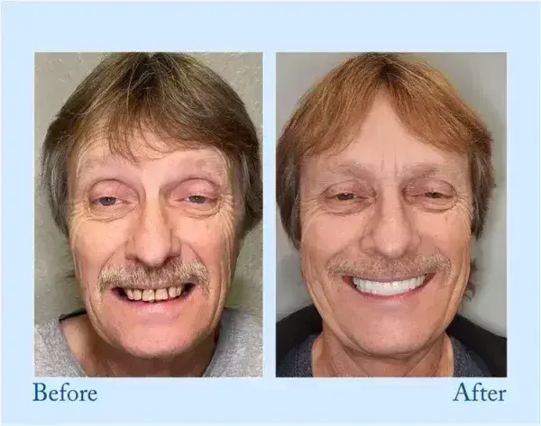 Hidone™ – Premium-Zahnprothese