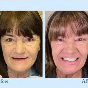 Hidone™ – Premium-Zahnprothese