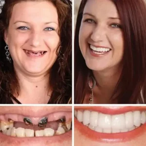 –Ends Today: 75% OFF! ⏰DarkFairy™ Medical Full Denture with Strong Suctiond Custom-Fit Full Functional Dentures🦷