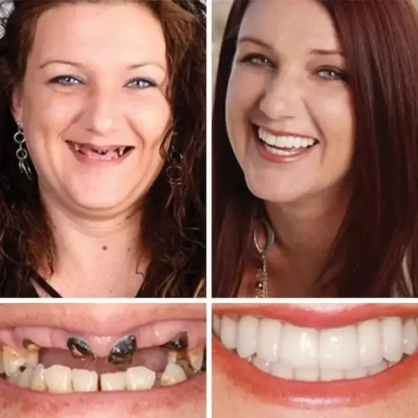 –Ends Today: 75% OFF! ⏰DarkFairy™ Medical Full Denture with Strong Suctiond Custom-Fit Full Functional Dentures🦷