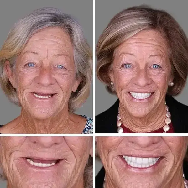 –Ends Today: 75% OFF! ⏰DarkFairy™ Medical Full Denture with Strong Suctiond Custom-Fit Full Functional Dentures🦷