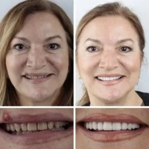 –Ends Today: 75% OFF! ⏰DarkFairy™ Medical Full Denture with Strong Suctiond Custom-Fit Full Functional Dentures🦷