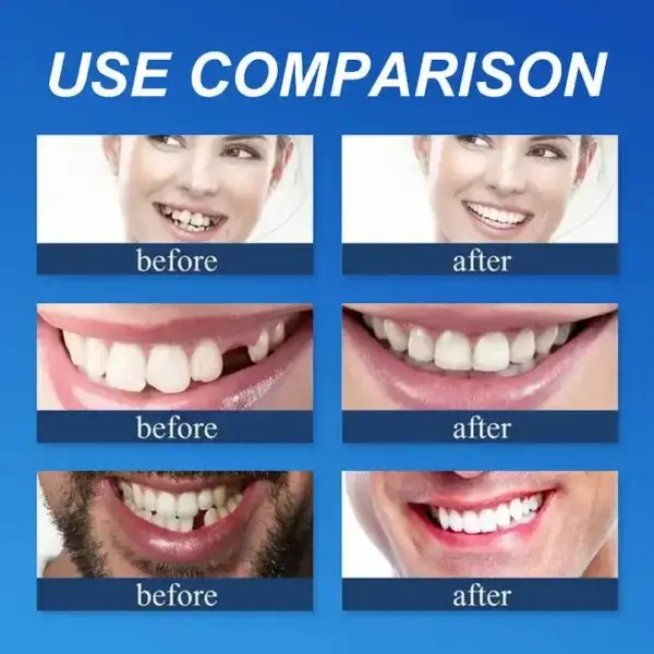 –Ends Today: 75% OFF! ⏰DarkFairy™ Medical Full Denture with Strong Suctiond Custom-Fit Full Functional Dentures🦷
