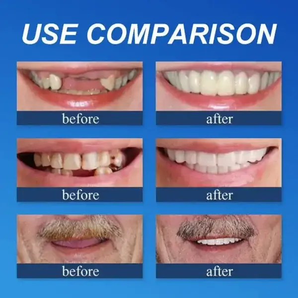 –Ends Today: 75% OFF! ⏰DarkFairy™ Medical Full Denture with Strong Suctiond Custom-Fit Full Functional Dentures🦷