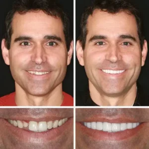 –Ends Today: 75% OFF! ⏰DarkFairy™ Medical Full Denture with Strong Suctiond Custom-Fit Full Functional Dentures🦷