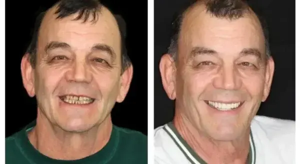 Vaxflite™ PREMIUM DENTURES