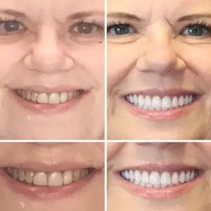 Vaxflite™ PREMIUM DENTURES