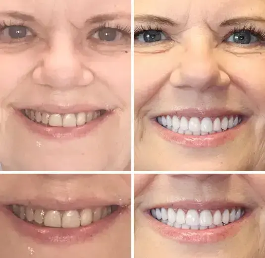 Vaxflite™ PREMIUM DENTURES